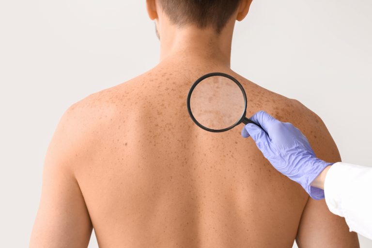 Answers From a Skin Cancer Doctor in Potomac