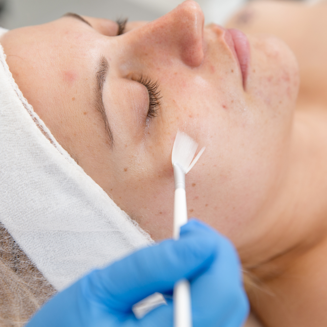 top chemcial peels for spring