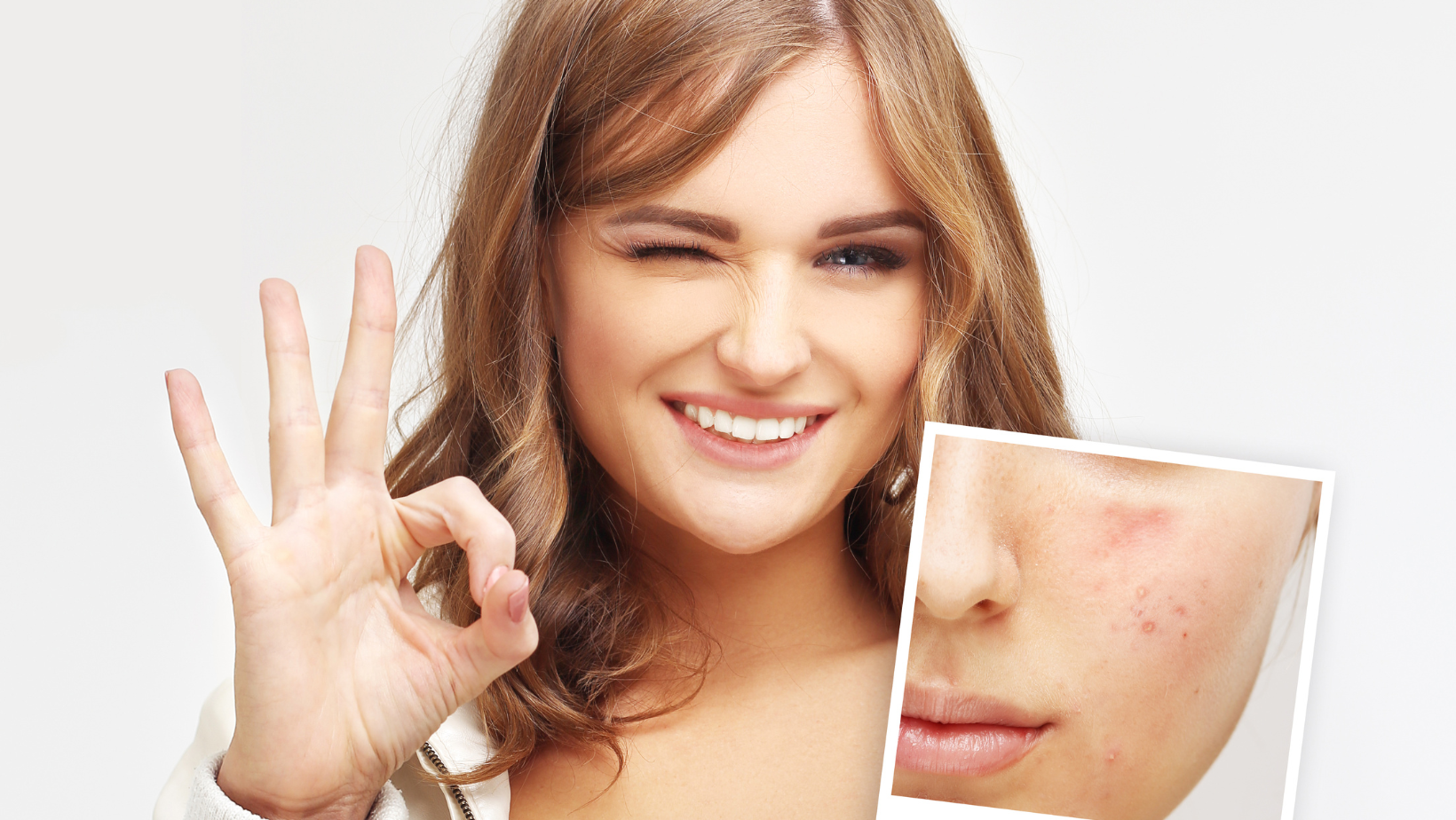 How to Get Rid of Acne Scars Chevy Chase