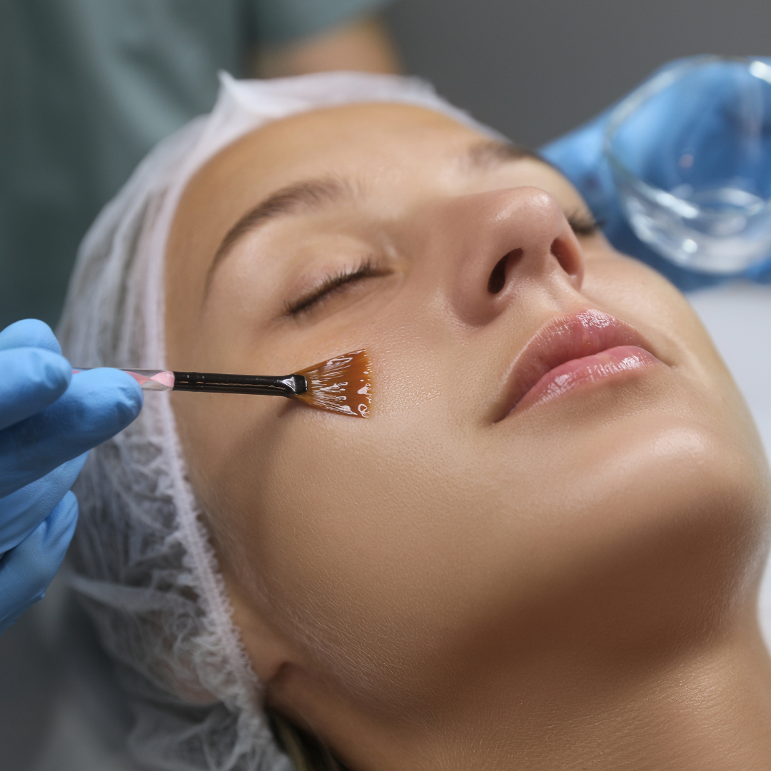 Chemical peels from a dermatologist