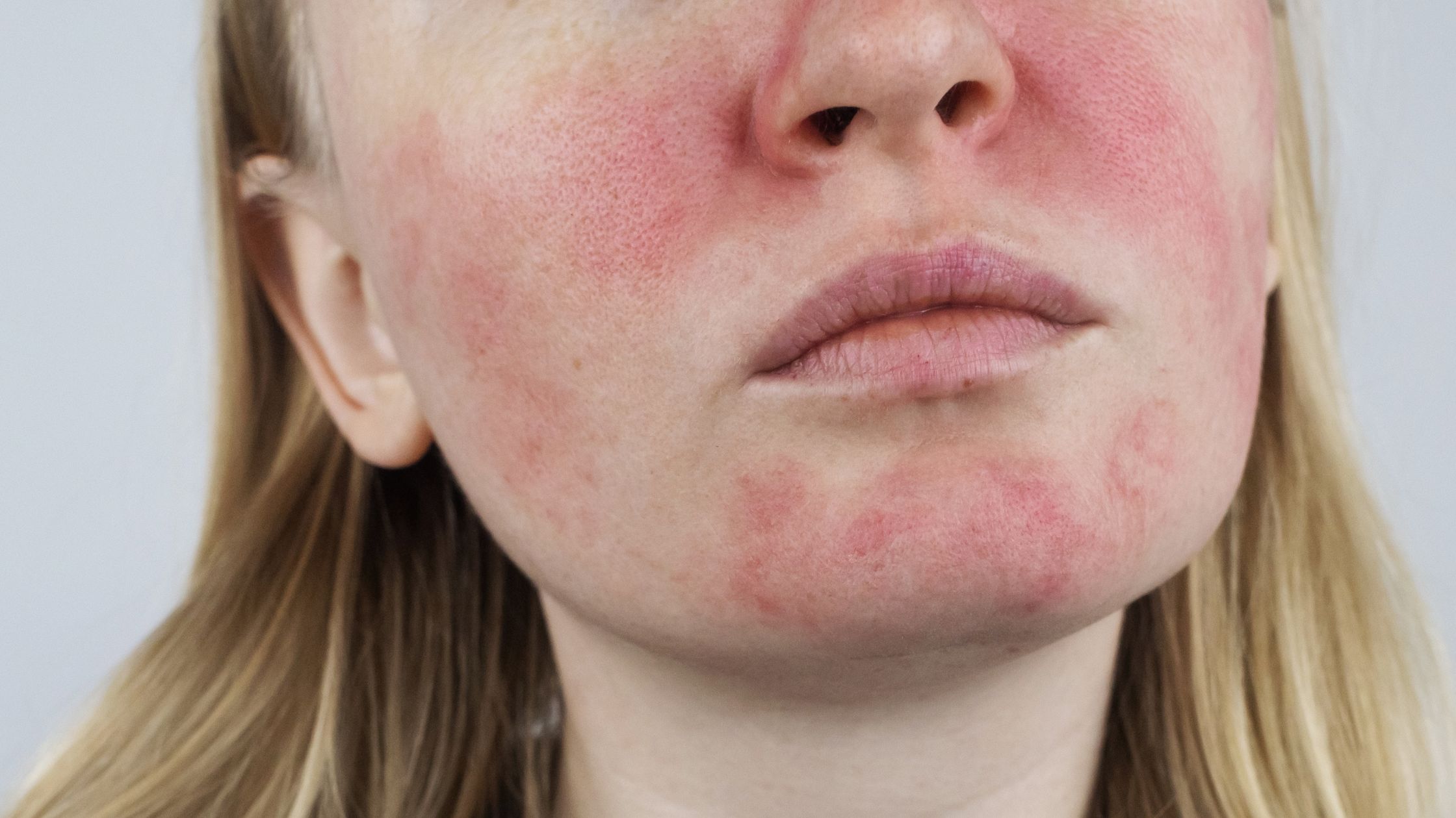 Preventing Rosacea Flare Ups in Denton