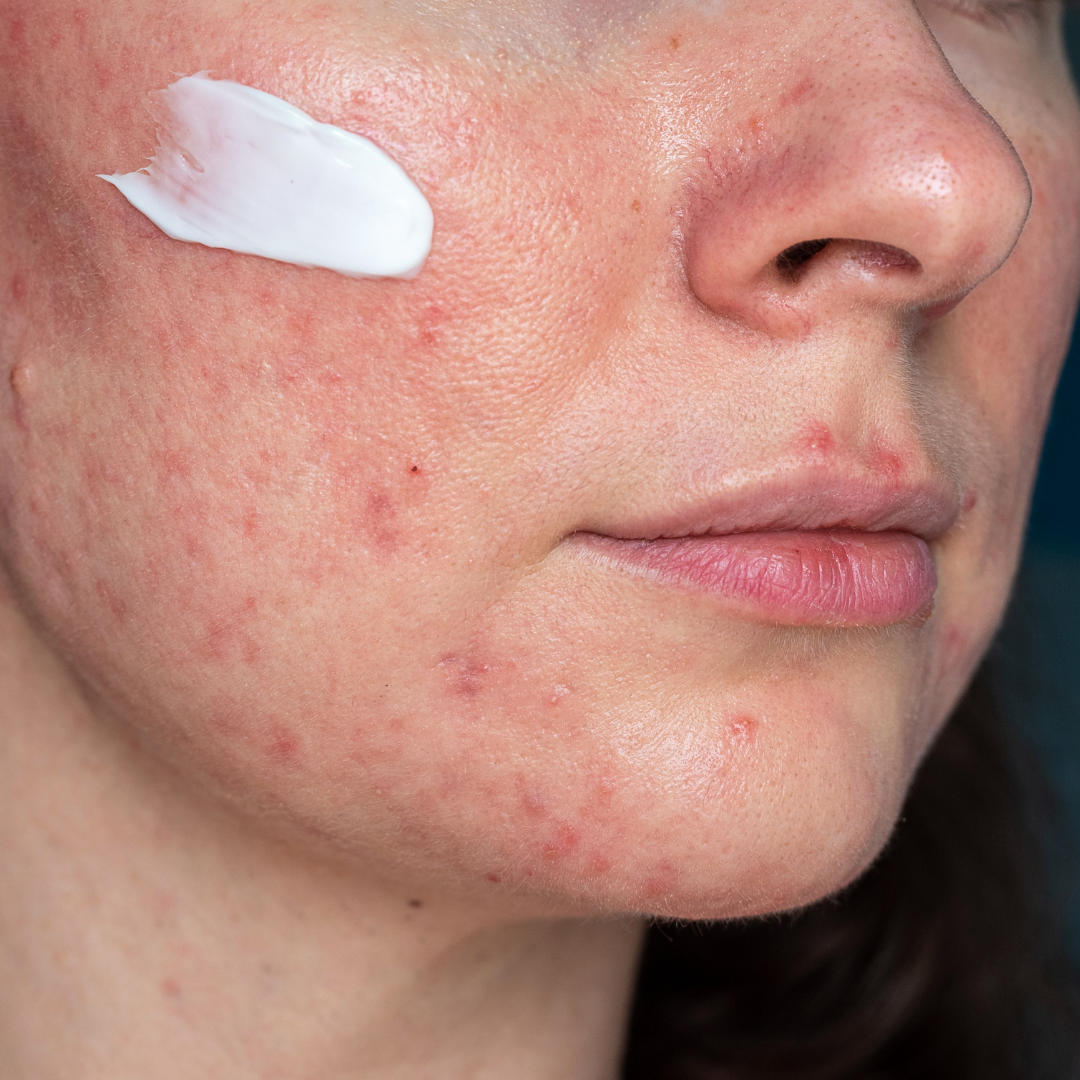 Preventing Rosacea Flare Ups in Denton