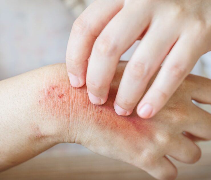 Contact Dermatitis Treatment Eastern Shore