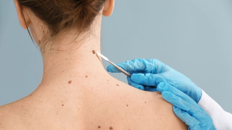 skin cancer specialist Easton