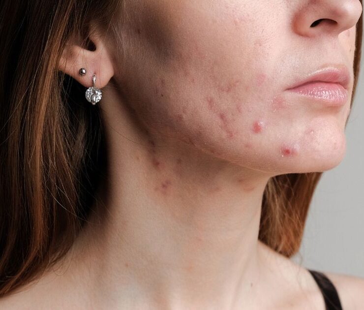 hormonal acne chevy chase