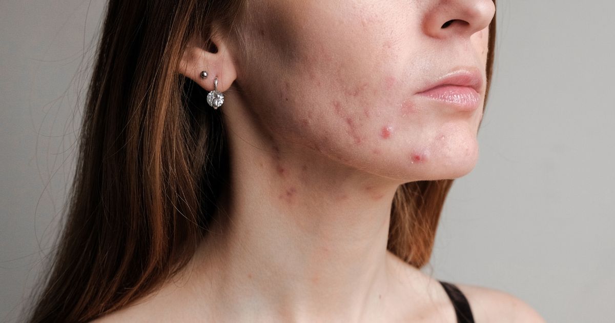 hormonal acne chevy chase