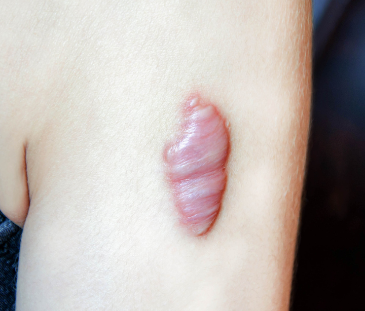 Keloid Scar Removal Chevy Chase