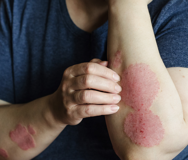 Best Psoriasis Treatments in Easton