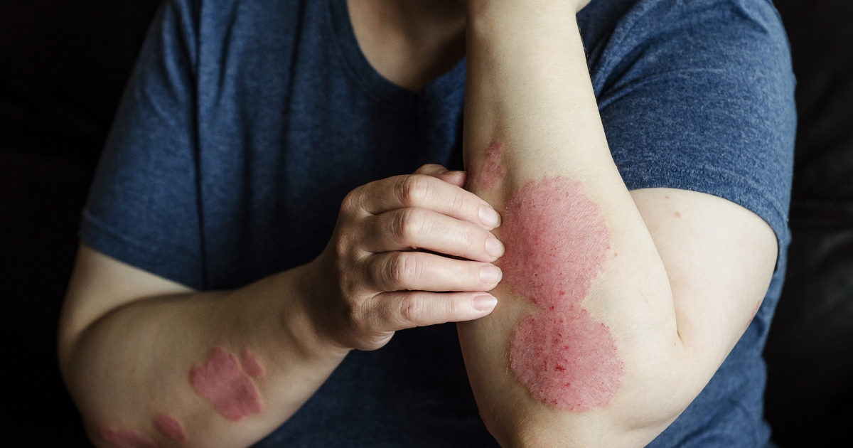 Best Psoriasis Treatments in Easton