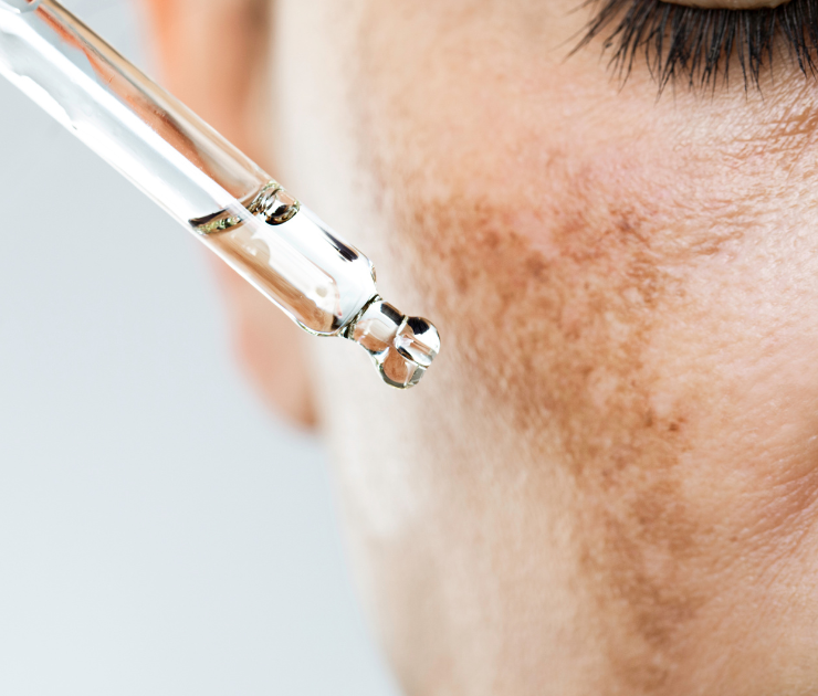 Dermatologist Recommended Hyperpigmentation Treatments in Eastern Shore Maryland