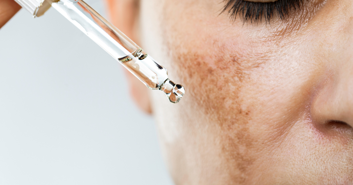 Dermatologist Recommended Hyperpigmentation Treatments in Eastern Shore Maryland