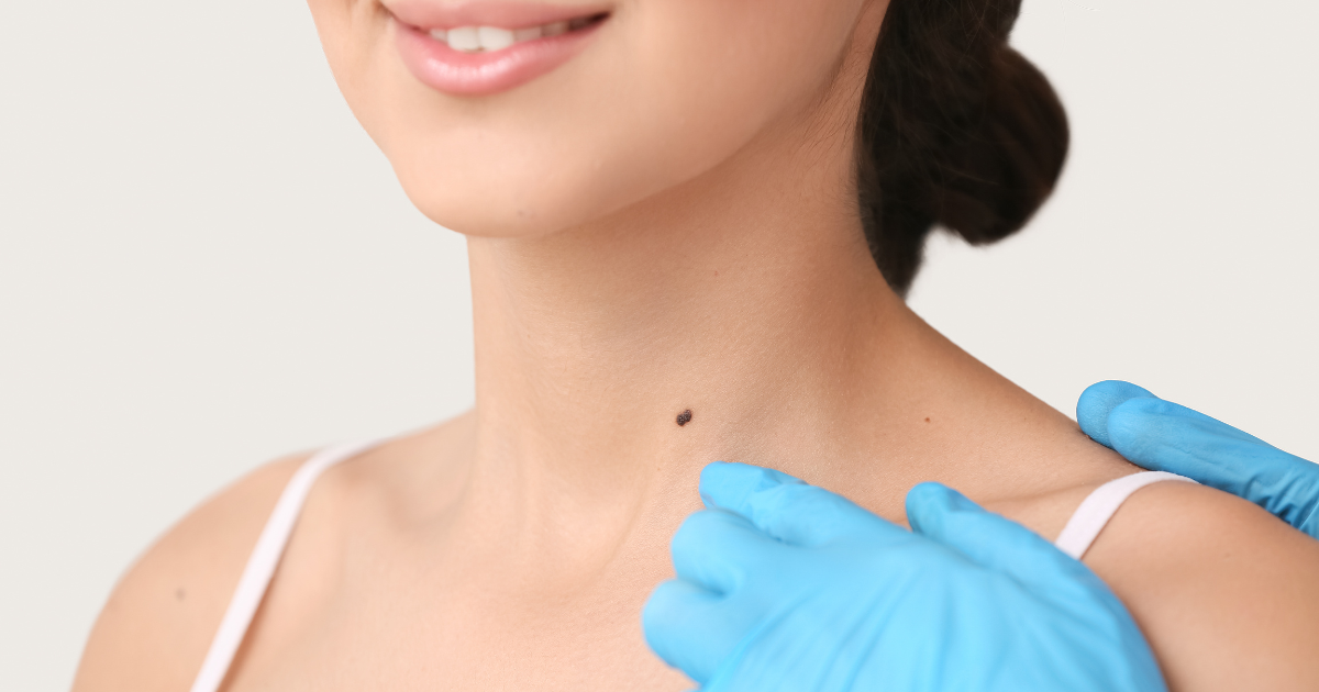 mole removal dermatologist