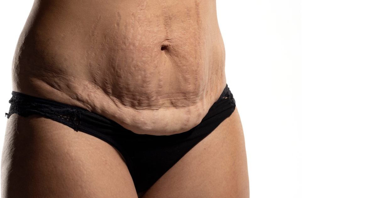 stretch mark removal Chevy Chase