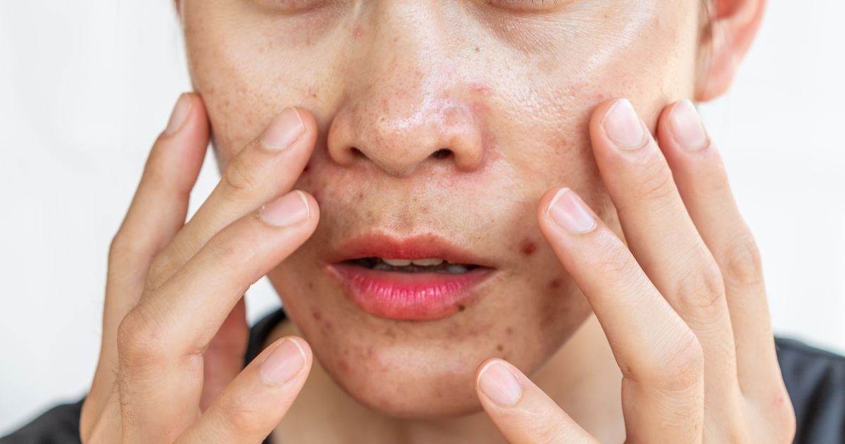 Dermatologist for Oily Skin