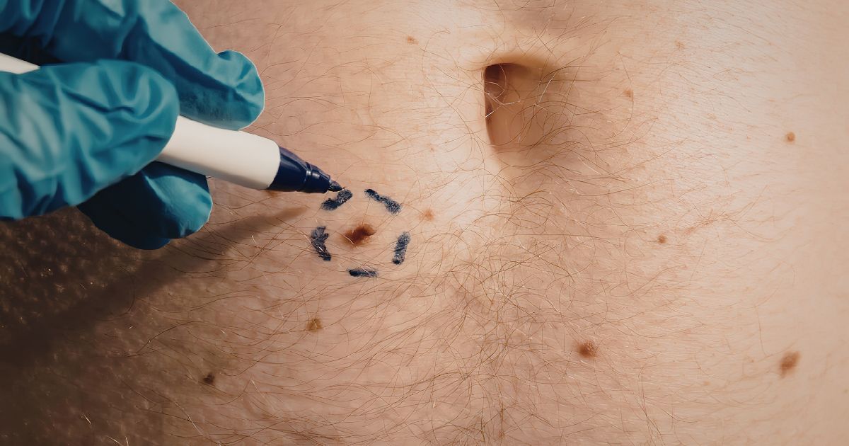 skin biopsy dermatologist in Maryland