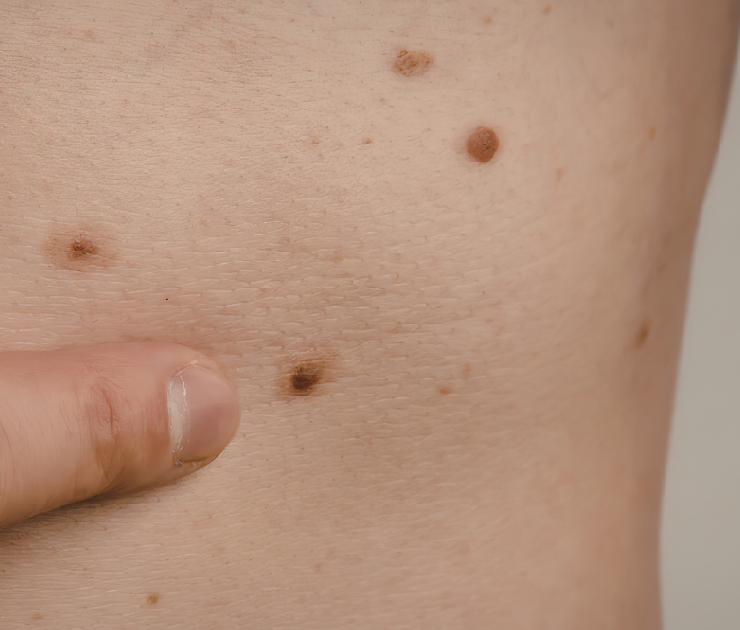 how to do a self-check on skin