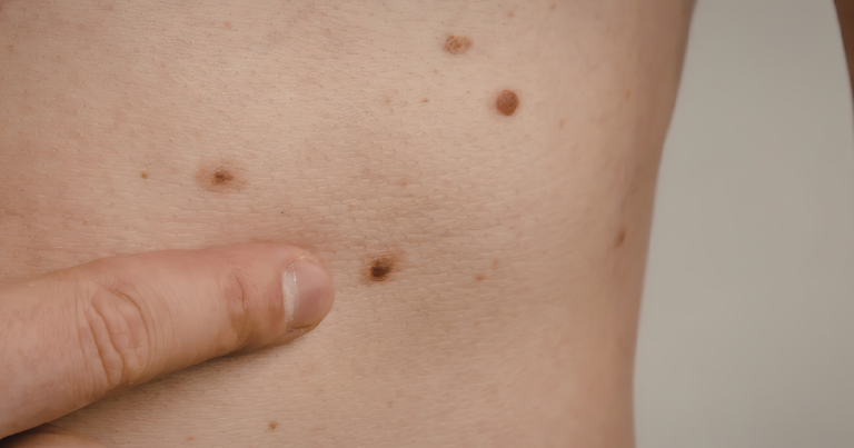 how to do a self-check on skin