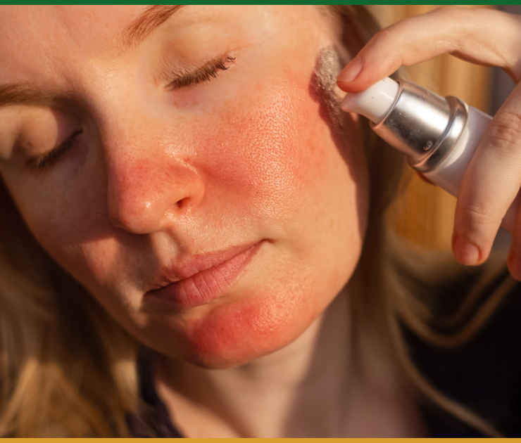 Best Rosacea Treatment Chevy Chase