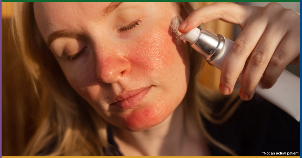 Best Rosacea Treatment Chevy Chase