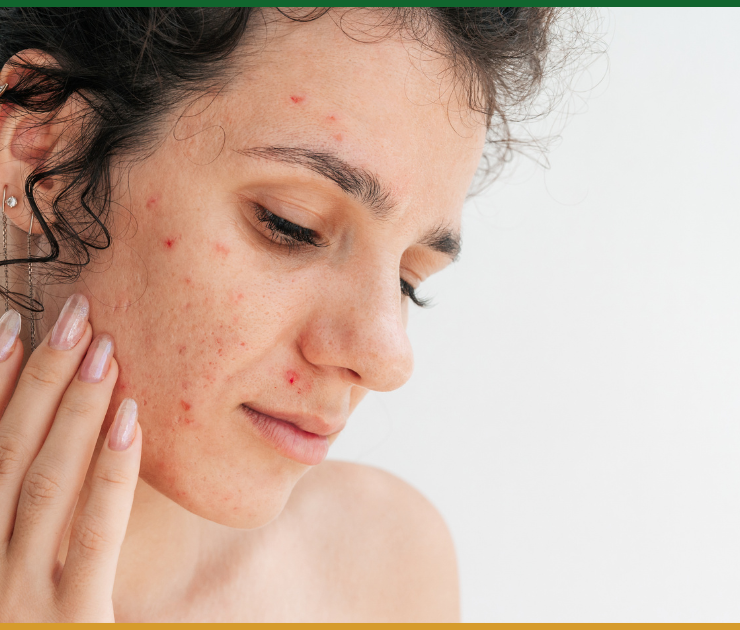 Best Acne Scar Treatment Near Me