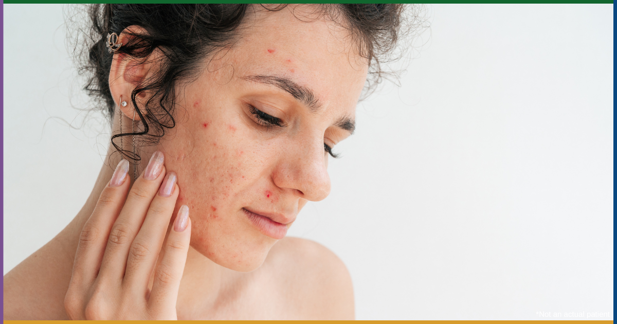 Best Acne Scar Treatment Near Me