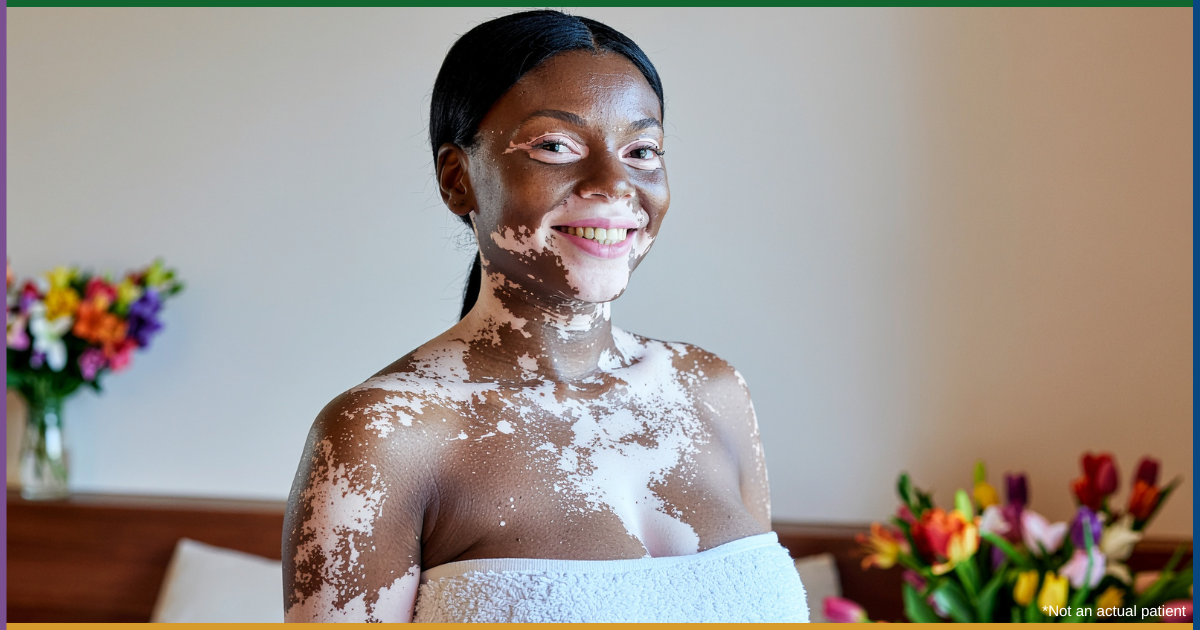 Best Vitiligo Treatments in Chevy Chase