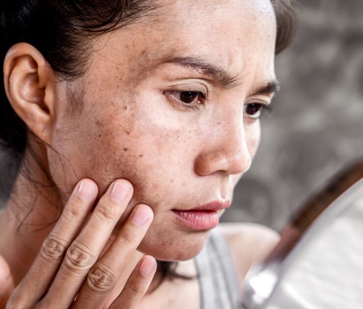 Melasma Treatment in Chevy Chase