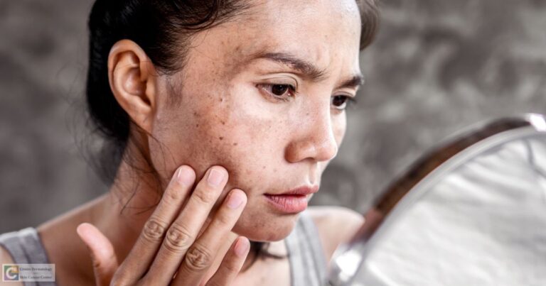 Melasma Treatment in Chevy Chase