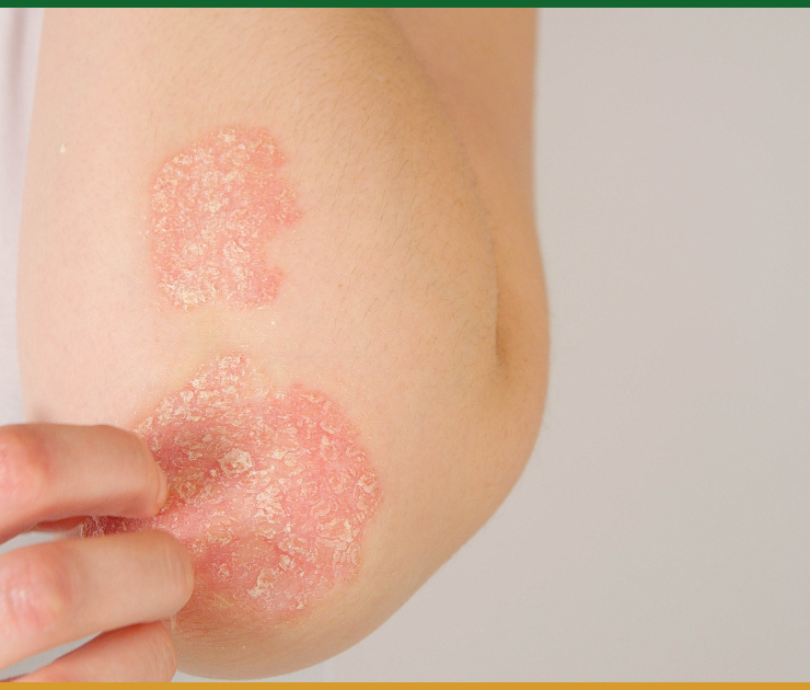 Is it Eczema or Psoriasis? How to Tell the Difference