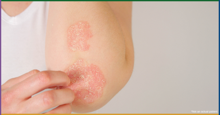 Is it Eczema or Psoriasis? How to Tell the Difference