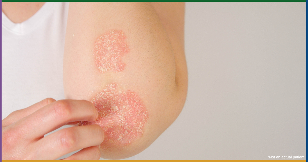 Is it Eczema or Psoriasis? How to Tell the Difference