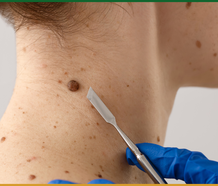 Laser Treatment for Seborrheic Keratosis