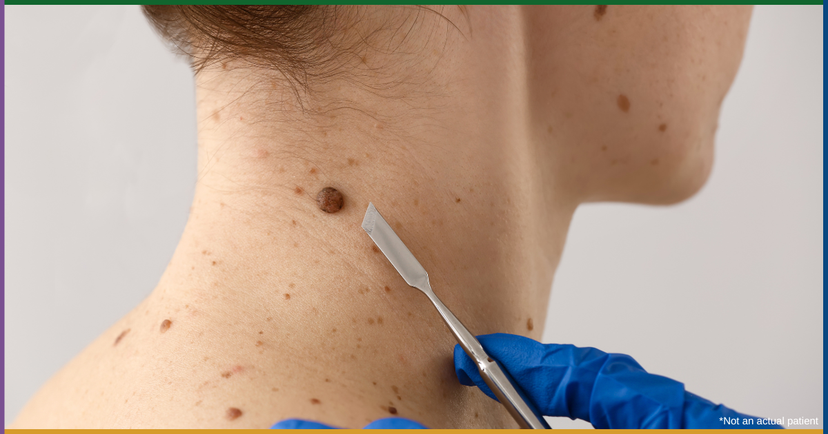 Laser Treatment for Seborrheic Keratosis